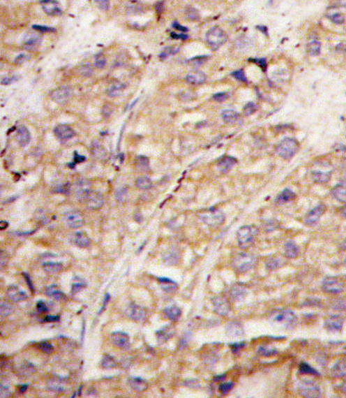 Formalin-fixed and paraffin-embedded human breast carcinoma tissue reacted with hSMURF1-W81 (Cat.#AP11952PU-N), which was peroxidase-conjugated to the secondary antibody, followed by DAB staining. This data demonstrates the use of this antibody for immunohistochemistry; clinical relevance has not been evaluated.
