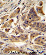 RBCK1 (UBCE7IP3) Antibody (N-term) (Cat. #AP2107A)immunohistochemistry analysis in formalin fixed and paraffin embedded human bladder carcinoma followed by peroxidase conjugation of the secondary antibody and DAB staining.This data demonstrates the use of RBCK1 (UBCE7IP3) Antibody (N-term) for immunohistochemistry.  Clinical relevance has not been evaluated.
