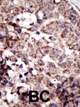 Formalin-fixed and paraffin-embedded human cancer tissue reacted with the primary antibody, which was peroxidase-conjugated to the secondary antibody, followed by AEC staining. This data demonstrates the use of this antibody for immunohistochemistry; clinical relevance has not been evaluated. BC = breast carcinoma; HC = hepatocarcinoma.