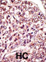 Formalin-fixed and paraffin-embedded human cancer tissue reacted with the primary antibody, which was peroxidase-conjugated to the secondary antibody, followed by AEC staining. This data demonstrates the use of this antibody for immunohistochemistry; clinical relevance has not been evaluated. BC = breast carcinoma; HC = hepatocarcinoma.