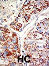 Formalin-fixed and paraffin-embedded human cancer tissue reacted with the primary antibody, which was peroxidase-conjugated to the secondary antibody, followed by DAB staining. This data demonstrates the use of this antibody for immunohistochemistry; clinical relevance has not been evaluated. BC = breast carcinoma; HC = hepatocarcinoma.