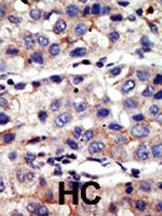 Formalin-fixed and paraffin-embedded human cancer tissue reacted with the primary antibody, which was peroxidase-conjugated to the secondary antibody, followed by AEC staining. This data demonstrates the use of this antibody for immunohistochemistry; clinical relevance has not been evaluated. BC = breast carcinoma; HC = hepatocarcinoma.