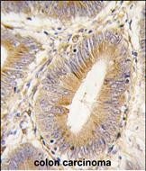 Formalin-fixed and paraffin-embedded human colon carcinoma tissue reacted with AKR1B1 antibody (Center) (Cat.#AP2735c), which was peroxidase-conjugated to the secondary antibody, followed by DAB staining. This data demonstrates the use of this antibody for immunohistochemistry; clinical relevance has not been evaluated.
