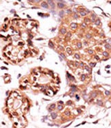 Formalin-fixed and paraffin-embedded human cancer tissue reacted with the primary antibody, which was peroxidase-conjugated to the secondary antibody, followed by AEC staining. This data demonstrates the use of this antibody for immunohistochemistry; clinical relevance has not been evaluated. BC = breast carcinoma; HC = hepatocarcinoma.