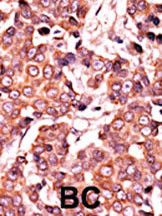 Formalin-fixed and paraffin-embedded human cancer tissue reacted with the primary antibody, which was peroxidase-conjugated to the secondary antibody, followed by AEC staining. This data demonstrates the use of this antibody for immunohistochemistry; clinical relevance has not been evaluated. BC = breast carcinoma; HC = hepatocarcinoma.