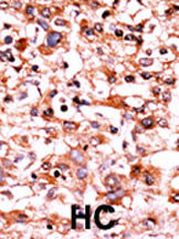 Formalin-fixed and paraffin-embedded human cancer tissue reacted with the primary antibody, which was peroxidase-conjugated to the secondary antibody, followed by AEC staining. This data demonstrates the use of this antibody for immunohistochemistry; clinical relevance has not been evaluated. BC = breast carcinoma; HC = hepatocarcinoma.