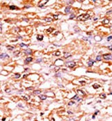 Formalin-fixed and paraffin-embedded human cancer tissue reacted with the primary antibody, which was peroxidase-conjugated to the secondary antibody, followed by AEC staining. This data demonstrates the use of this antibody for immunohistochemistry; clinical relevance has not been evaluated. BC = breast carcinoma; HC = hepatocarcinoma.
