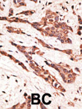Formalin-fixed and paraffin-embedded human cancer tissue reacted with the primary antibody, which was peroxidase-conjugated to the secondary antibody, followed by AEC staining. This data demonstrates the use of this antibody for immunohistochemistry; clinical relevance has not been evaluated. BC = breast carcinoma; HC = hepatocarcinoma.