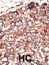 Formalin-fixed and paraffin-embedded human cancer tissue reacted with the primary antibody, which was peroxidase-conjugated to the secondary antibody, followed by DAB staining. This data demonstrates the use of this antibody for immunohistochemistry; clinical relevance has not been evaluated. BC = breast carcinoma; HC = hepatocarcinoma.