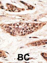 Formalin-fixed and paraffin-embedded human cancer tissue reacted with the primary antibody, which was peroxidase-conjugated to the secondary antibody, followed by AEC staining. This data demonstrates the use of this antibody for immunohistochemistry; clinical relevance has not been evaluated. BC = breast carcinoma; HC = hepatocarcinoma.