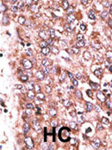 Formalin-fixed and paraffin-embedded human cancer tissue reacted with the primary antibody, which was peroxidase-conjugated to the secondary antibody, followed by DAB staining. This data demonstrates the use of this antibody for immunohistochemistry; clinical relevance has not been evaluated. BC = breast carcinoma; HC = hepatocarcinoma.