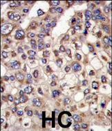 Formalin-fixed and paraffin-embedded human hepatocarcinoma tissue reacted with MTMR4 antibody (C-term), which was peroxidase-conjugated to the secondary antibody, followed by DAB staining. This data demonstrates the use of this antibody for immunohistochemistry; clinical relevance has not been evaluated.