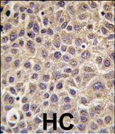 Formalin-fixed and paraffin-embedded human hepatocarcinoma tissue reacted with MTMR9 antibody , which was peroxidase-conjugated to the secondary antibody, followed by DAB staining. This data demonstrates the use of this antibody for immunohistochemistry; clinical relevance has not been evaluated.