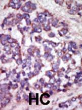 Formalin-fixed and paraffin-embedded human cancer tissue reacted with the primary antibody, which was peroxidase-conjugated to the secondary antibody, followed by AEC staining. This data demonstrates the use of this antibody for immunohistochemistry; clinical relevance has not been evaluated. BC = breast carcinoma; HC = hepatocarcinoma.