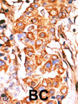 Formalin-fixed and paraffin-embedded human cancer tissue reacted with the primary antibody, which was peroxidase-conjugated to the secondary antibody, followed by AEC staining. This data demonstrates the use of this antibody for immunohistochemistry; clinical relevance has not been evaluated. BC = breast carcinoma; HC = hepatocarcinoma.