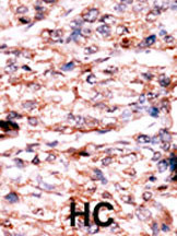 Formalin-fixed and paraffin-embedded human cancer tissue reacted with the primary antibody, which was peroxidase-conjugated to the secondary antibody, followed by AEC staining. This data demonstrates the use of this antibody for immunohistochemistry; clinical relevance has not been evaluated. BC = breast carcinoma; HC = hepatocarcinoma.