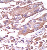 Formalin-fixed and paraffin-embedded human cancer tissue reacted with the primary antibody, which was peroxidase-conjugated to the secondary antibody, followed by AEC staining. This data demonstrates the use of this antibody for immunohistochemistry; clinical relevance has not been evaluated. BC = breast carcinoma; HC = hepatocarcinoma.