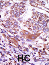 Formalin-fixed and paraffin-embedded human cancer tissue reacted with the primary antibody, which was peroxidase-conjugated to the secondary antibody, followed by AEC staining. This data demonstrates the use of this antibody for immunohistochemistry; clinical relevance has not been evaluated. BC = breast carcinoma; HC = hepatocarcinoma.