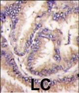 Formalin-fixed and paraffin-embedded human lung carcinoma tissue reacted with STK9 Antibody (C-term)(Cat.#AP13936PU-N), which was peroxidase-conjugated to the secondary antibody, followed by DAB staining. This data demonstrates the use of this antibody for immunohistochemistry; clinical relevance has not been evaluated.