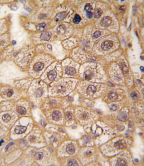 Formalin-fixed and paraffin-embedded human hepatocarcinoma tissue reacted with BAR2 Antibody (S261) (Cat.#AP13972PU-N), which was peroxidase-conjugated to the secondary antibody, followed by DAB staining. This data demonstrates the use of this antibody for immunohistochemistry; clinical relevance has not been evaluated.