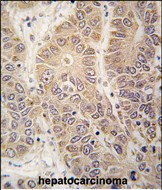 Formalin-fixed and paraffin-embedded human hepatocarcinoma tissue reacted with HARS antibody (N-term) (Cat.#AP14214PU-N), which was peroxidase-conjugated to the secondary antibody, followed by DAB staining. This data demonstrates the use of this antibody for immunohistochemistry; clinical relevance has not been evaluated.