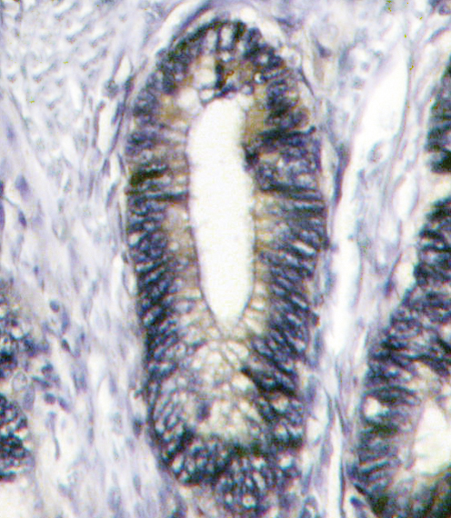 Formalin-fixed and paraffin-embedded human breast carcinoma reacted with EphB2 Antibody (C-term)(Cat.#AP14297PU-N), which was peroxidase-conjugated to the secondary antibody, followed by DAB staining. This data demonstrates the use of this antibody for immunohistochemistry; clinical relevance has not been evaluated.