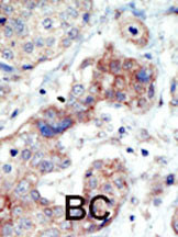 Formalin-fixed and paraffin-embedded human cancer tissue reacted with the primary antibody, which was peroxidase-conjugated to the secondary antibody, followed by DAB staining. This data demonstrates the use of this antibody for immunohistochemistry; clinical relevance has not been evaluated. BC = breast carcinoma; HC = hepatocarcinoma.