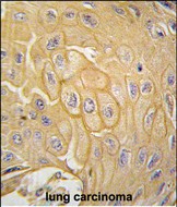 Formalin-fixed and paraffin-embedded human lung carcinoma tissue reacted with MCK10 antibody (Cat.#AP14383PU-N), which was peroxidase-conjugated to the secondary antibody, followed by DAB staining. This data demonstrates the use of this antibody for immunohistochemistry; clinical relevance has not been evaluated.