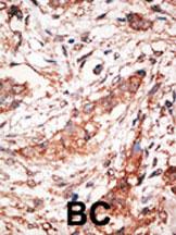 Formalin-fixed and paraffin-embedded human cancer tissue reacted with the primary antibody, which was peroxidase-conjugated to the secondary antibody, followed by DAB staining. This data demonstrates the use of this antibody for immunohistochemistry; clinical relevance has not been evaluated. BC = breast carcinoma; HC = hepatocarcinoma.