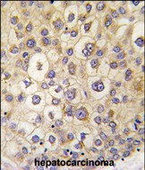 Formalin-fixed and paraffin-embedded human hepatocarcinoma tissue reacted with ARHE antibody (Center) (Cat.#AP14531PU-N), which was peroxidase-conjugated to the secondary antibody, followed by DAB staining. This data demonstrates the use of this antibody for immunohistochemistry; clinical relevance has not been evaluated.