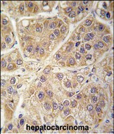 Formalin-fixed and paraffin-embedded human hepatocarcinoma tissue reacted with SARS2 antibody (Center) (Cat.#AP14669PU-N), which was peroxidase-conjugated to the secondary antibody, followed by DAB staining. This data demonstrates the use of this antibody for immunohistochemistry; clinical relevance has not been evaluated.