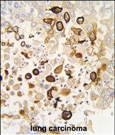 Formalin-fixed and paraffin-embedded human lung carcinoma tissue reacted with CYP4X1 antibody (N-term), which was peroxidase-conjugated to the secondary antibody, followed by DAB staining. This data demonstrates the use of this antibody for immunohistochemistry; clinical relevance has not been evaluated.