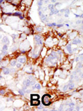 Formalin-fixed and paraffin-embedded human cancer tissue reacted with the primary antibody, which was peroxidase-conjugated to the secondary antibody, followed by AEC staining. This data demonstrates the use of this antibody for immunohistochemistry; clinical relevance has not been evaluated. BC = breast carcinoma; HC = hepatocarcinoma.
