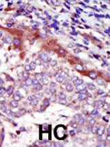 Formalin-fixed and paraffin-embedded human cancer tissue reacted with the primary antibody, which was peroxidase-conjugated to the secondary antibody, followed by AEC staining. This data demonstrates the use of this antibody for immunohistochemistry; clinical relevance has not been evaluated. BC = breast carcinoma; HC = hepatocarcinoma.