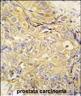 Formalin-fixed and paraffin-embedded human prostata carcinoma tissue reacted with FGF10 antibody (C-term) (Cat.#AP7975b), which was peroxidase-conjugated to the secondary antibody, followed by DAB staining. This data demonstrates the use of this antibody for immunohistochemistry; clinical relevance has not been evaluated.