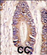 Formalin-fixed and paraffin-embedded human colon carcinoma tissue reacted with  MLK4 antibody (N-term) (Cat.#AP14913PU-N), which was peroxidase-conjugated to the secondary antibody, followed by DAB staining. This data demonstrates the use of this antibody for immunohistochemistry; clinical relevance has not been evaluated.