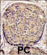 Formalin-fixed and paraffin-embedded human prostata carcinoma tissue reacted with PI3KCB antibody (C-term), which was peroxidase-conjugated to the secondary antibody, followed by DAB staining. This data demonstrates the use of this antibody for immunohistochemistry; clinical relevance has not been evaluated.