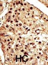 Formalin-fixed and paraffin-embedded human cancer tissue reacted with the primary antibody, which was peroxidase-conjugated to the secondary antibody, followed by DAB staining. This data demonstrates the use of this antibody for immunohistochemistry; clinical relevance has not been evaluated. BC = breast carcinoma; HC = hepatocarcinoma.