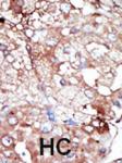 Formalin-fixed and paraffin-embedded human cancer tissue reacted with the primary antibody, which was peroxidase-conjugated to the secondary antibody, followed by DAB staining. This data demonstrates the use of this antibody for immunohistochemistry; clinical relevance has not been evaluated. BC = breast carcinoma; HC = hepatocarcinoma.