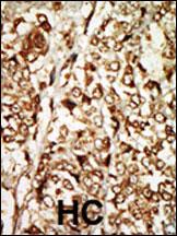Formalin-fixed and paraffin-embedded human cancer tissue reacted with the primary antibody, which was peroxidase-conjugated to the secondary antibody, followed by AEC staining. This data demonstrates the use of this antibody for immunohistochemistry; clinical relevance has not been evaluated. BC = breast carcinoma; HC = hepatocarcinoma.