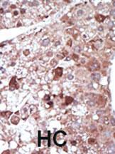 Formalin-fixed and paraffin-embedded human cancer tissue reacted with the primary antibody, which was peroxidase-conjugated to the secondary antibody, followed by DAB staining. This data demonstrates the use of this antibody for immunohistochemistry; clinical relevance has not been evaluated. BC = breast carcinoma; HC = hepatocarcinoma.