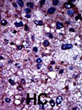 Formalin-fixed and paraffin-embedded human cancer tissue reacted with the primary antibody, which was peroxidase-conjugated to the secondary antibody, followed by DAB staining. This data demonstrates the use of this antibody for immunohistochemistry; clinical relevance has not been evaluated. BC = breast carcinoma; HC = hepatocarcinoma.