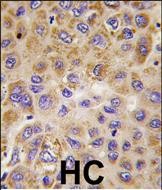 Formalin-fixed and paraffin-embedded human hepatocarcinoma tissue reacted with PFKFB1 antibody (Center), which was peroxidase-conjugated to the secondary antibody, followed by DAB staining. This data demonstrates the use of this antibody for immunohistochemistry; clinical relevance has not been evaluated.