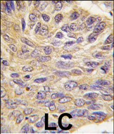 Formalin-fixed and paraffin-embedded human lung carcinoma tissue reacted with MEG2 antibody (C-term), which was peroxidase-conjugated to the secondary antibody, followed by DAB staining. This data demonstrates the use of this antibody for immunohistochemistry; clinical relevance has not been evaluated.