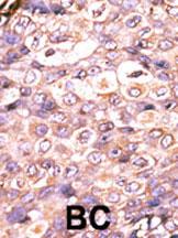 Formalin-fixed and paraffin-embedded human cancer tissue reacted with the primary antibody, which was peroxidase-conjugated to the secondary antibody, followed by AEC staining. This data demonstrates the use of this antibody for immunohistochemistry; clinical relevance has not been evaluated. BC = breast carcinoma; HC = hepatocarcinoma.