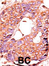 Formalin-fixed and paraffin-embedded human cancer tissue reacted with the primary antibody, which was peroxidase-conjugated to the secondary antibody, followed by AEC staining. This data demonstrates the use of this antibody for immunohistochemistry; clinical relevance has not been evaluated. BC = breast carcinoma; HC = hepatocarcinoma.