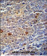 TRMO Antibody (C-term) (Cat. #AP17161PU-N) immunohistochemistry analysis in formalin fixed and paraffin embedded human skin carcinoma followed by peroxidase conjugation of the secondary antibody and DAB staining.  This data demonstrates the use of the TRMO Antibody (C-term) for immunohistochemistry.  Clinical relevance has not been evaluated.