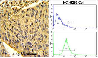 (LEFT)Formalin-fixed and paraffin-embedded human lung carcinoma with EPB41L4B Antibody (C-term), which was peroxidase-conjugated to the secondary antibody, followed by DAB staining. This data demonstrates the use of this antibody for immunohistochemistry; clinical relevance has not been evaluated.
(RIGHT)Flow cytometric analysis of NCI-H292 cells using EPB41L4B Antibody (C-term)(bottom histogram) compared to a negative control cell (top histogram). FITC-conjugated goat-anti-rabbit secondary antibodies were used for the analysis.