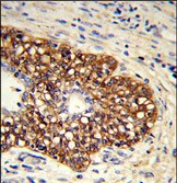 Formalin-fixed and paraffin-embedded human prostate carcinoma reacted with CYP8A1 Antibody (C-term) (Cat. #AP7997b), which was peroxidase-conjugated to the secondary antibody, followed by DAB staining. This data demonstrates the use of this antibody for immunohistochemistry; clinical relevance has not been evaluated.