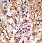 Formalin-fixed and paraffin-embedded human cancer tissue reacted with the primary antibody, which was peroxidase-conjugated to the secondary antibody, followed by DAB staining. This data demonstrates the use of this antibody for immunohistochemistry; clinical relevance has not been evaluated. BC = breast carcinoma; HC = hepatocarcinoma.